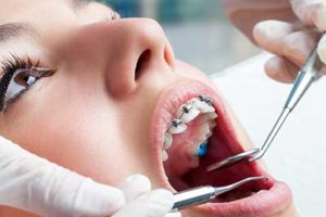 women with braces on and open mouth being examined by dentist, dental braces tx