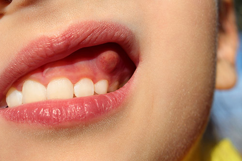 dental abscess treatment conroe tx an abscess in a patient mouth dental abscess treatment conroe tx