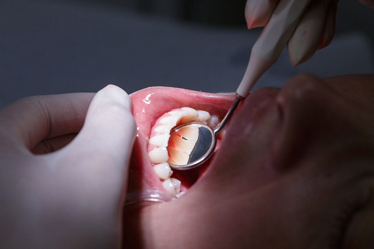 dentist showing causes of receding gums