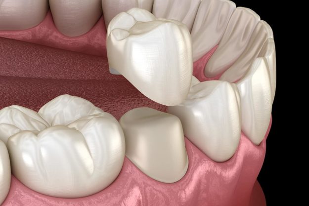 dental crowns dental crowns