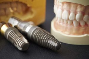 examples of dental implants