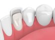 a tooth sample represents dental veneers
