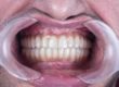 a man is scheduled to have dental implants