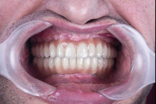 How Do Dental Implants Work a man is scheduled to have dental implants
