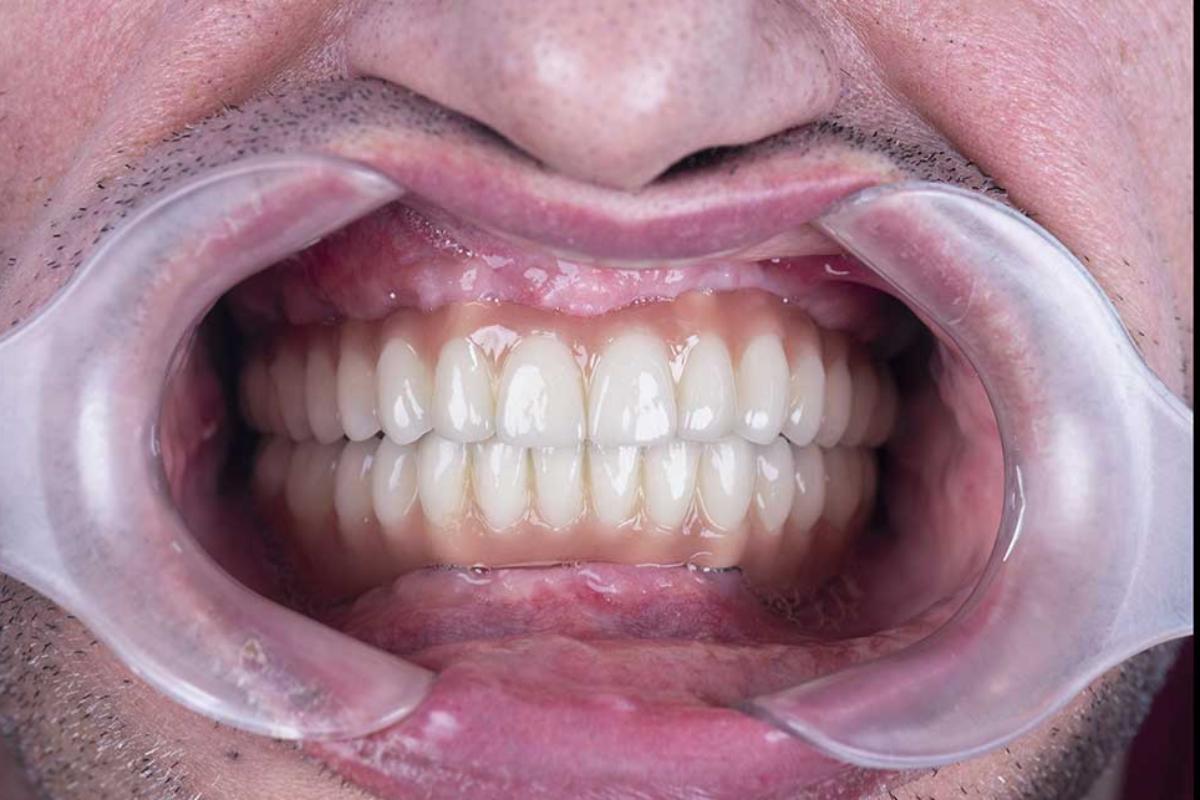 How Do Dental Implants Work? Implant Services TX